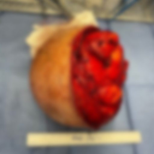 Neck Mass Surgery